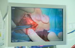 SPSK 4: operacja wszczepienia implantu ucha (zdjęcie 5)