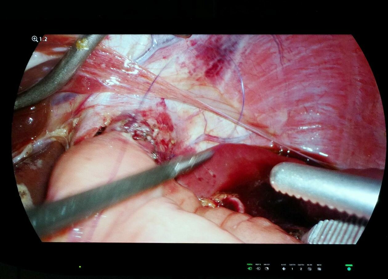  Operacja laparoskopowa w SPSK 1 (zdjęcie 4) - Autor: Maciej Kaczanowski