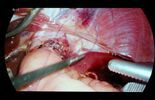 Operacja laparoskopowa w SPSK 1 (zdjęcie 4)
