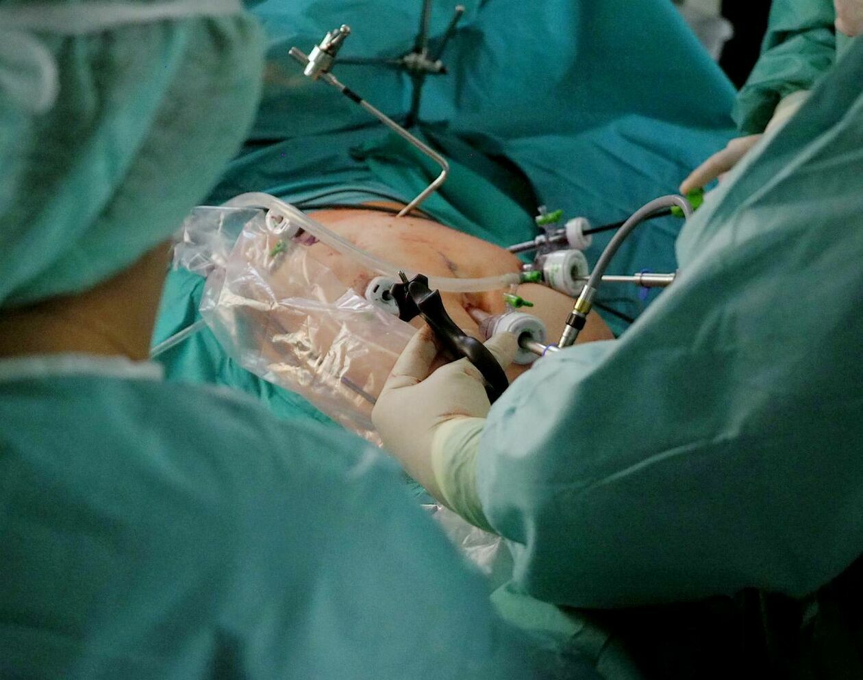  Operacja laparoskopowa w SPSK 1 (zdjęcie 3) - Autor: Maciej Kaczanowski