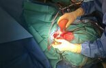 Operacja wycięcia guza mózgu w SPSK 4 w Lublinie (zdjęcie 3)
