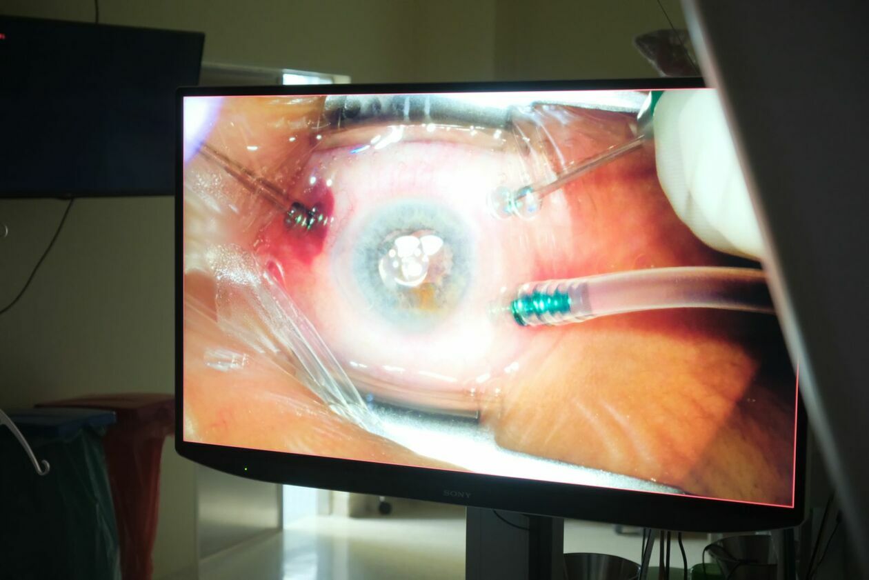  W klinice okulistyki podczas operacji oka testowany jest nowoczesny cyfrowy mikroskop 3D  - Autor: DW