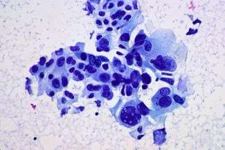 Jak powstaje nowotwór złośliwy?