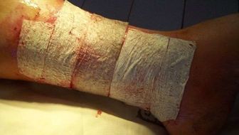 Niezwykły wynalazek lubelskich naukowców. Rany zagoją się szybciej, nie będzie blizn