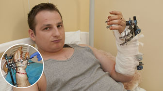 – Dziś wychodzę ze szpitala. Przez dwa miesiące ręka będzie w specjalnym rusztowaniu. Potem zacznę rehabilitację. Lekarze z Łęcznej to cudotwórcy. Dzięki nim mam rękę. Nie ma słów, aby podziękować doktorom – mówi Dziennikowi 24-letni Arkadiusz Lipiec