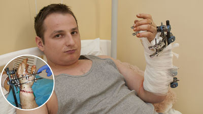 – Dziś wychodzę ze szpitala. Przez dwa miesiące ręka będzie w specjalnym rusztowaniu. Potem zacznę rehabilitację. Lekarze z Łęcznej to cudotwórcy. Dzięki nim mam rękę. Nie ma słów, aby podziękować doktorom – mówi Dziennikowi 24-letni Arkadiusz Lipiec