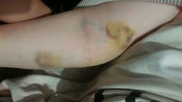 – Tak wygląda ręka Anny po transporcie szpitalną karetką – twierdzi pani Dorota
