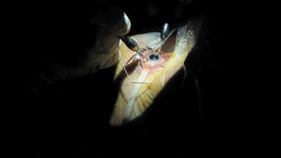 Po operacji zaćmy przy Kraśnickiej pacjenci z powikłaniami trafili do kliniki okulistycznej przy Chmielnej