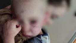 Zobaczyły w sieci  zdjęcia pobitego dziecka. Ustaliły, co się stało Aleksowi