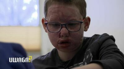 10-letni Tomek prawie spłonął w samochodzie. Po przeszczepach było dobrze, niestety teraz jest gorzej