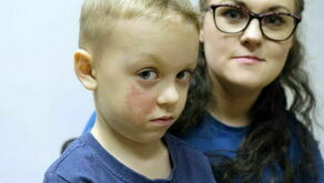 Chłopiec został opatrzony na SOR. Nadal jest pod opieką poradni przyszpitalnej we Wschodnim Centrum Leczenia Oparzeń i Chirurgii Rekonstrukcyjnej w Łęcznej.