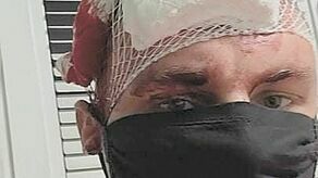 Przemysław Gilewicz, lider zespołu Nokaut, pokazał na swoim profilu, jak wyglądał po uderzeniu toporo-młotkiem w głowę