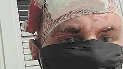 Przemysław Gilewicz, lider zespołu Nokaut, pokazał na swoim profilu, jak wyglądał po uderzeniu toporo-młotkiem w głowę