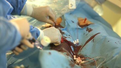 Lubelskie. Pacjentka po operacji została z chustą w brzuchu