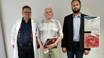 Pacjent, pan Roman (w środku) z lekarzami z lubelskiego SPSK 1: prof. Tomaszem Zubilewiczem i dr Tomaszem Pedowskim. Na zdjęciu w ramce brzuch z widocznym tętniakiem oraz podczas operacji