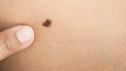 Wszelkie tego rodzaju znamiona warto przebadać