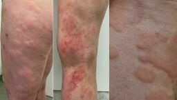 SPSK1 w Lublinie zaprasza na bezpłatne konsultacje w kierunku pokrzywki