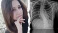 Dominika Ciemięga jest 13- letnia dziewczynką z Hrubieszowa, która zmaga się ze skoliozą