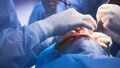 Usuwanie zaćmy: innowacyjne metody chirurgiczne w zwalczaniu problemu wzroku
