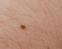 Dermatolog bezpłatnie zbada znamiona