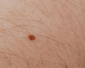 Dermatolog bezpłatnie zbada znamiona