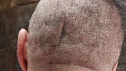 Po wypadku na rowerze pan Andrzej przeszedł skomplikowaną operację. Ślad po niej ma do dzisiaj