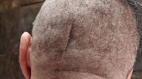 Po wypadku na rowerze pan Andrzej przeszedł skomplikowaną operację. Ślad po niej ma do dzisiaj