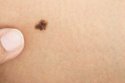 Znamiona pod lupą – podejrzany pieprzyk lepiej sprawdzić