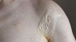 Ogień w roli głównej. Zaproszenie na wernisaż w Ratuszu